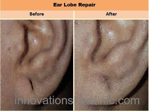 Ear-Lobe Repair 1